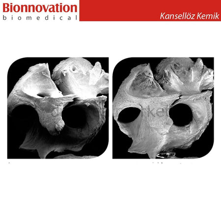 Bionnovation - Bonefill Prous (Cancellous) Bovine Graft - Xenograft - 0,5gr (1cc)