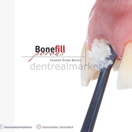 Bionnovation - Bonefill Prous (Cancellous) Bovine Graft - Xenograft - 5 gr (10cc)