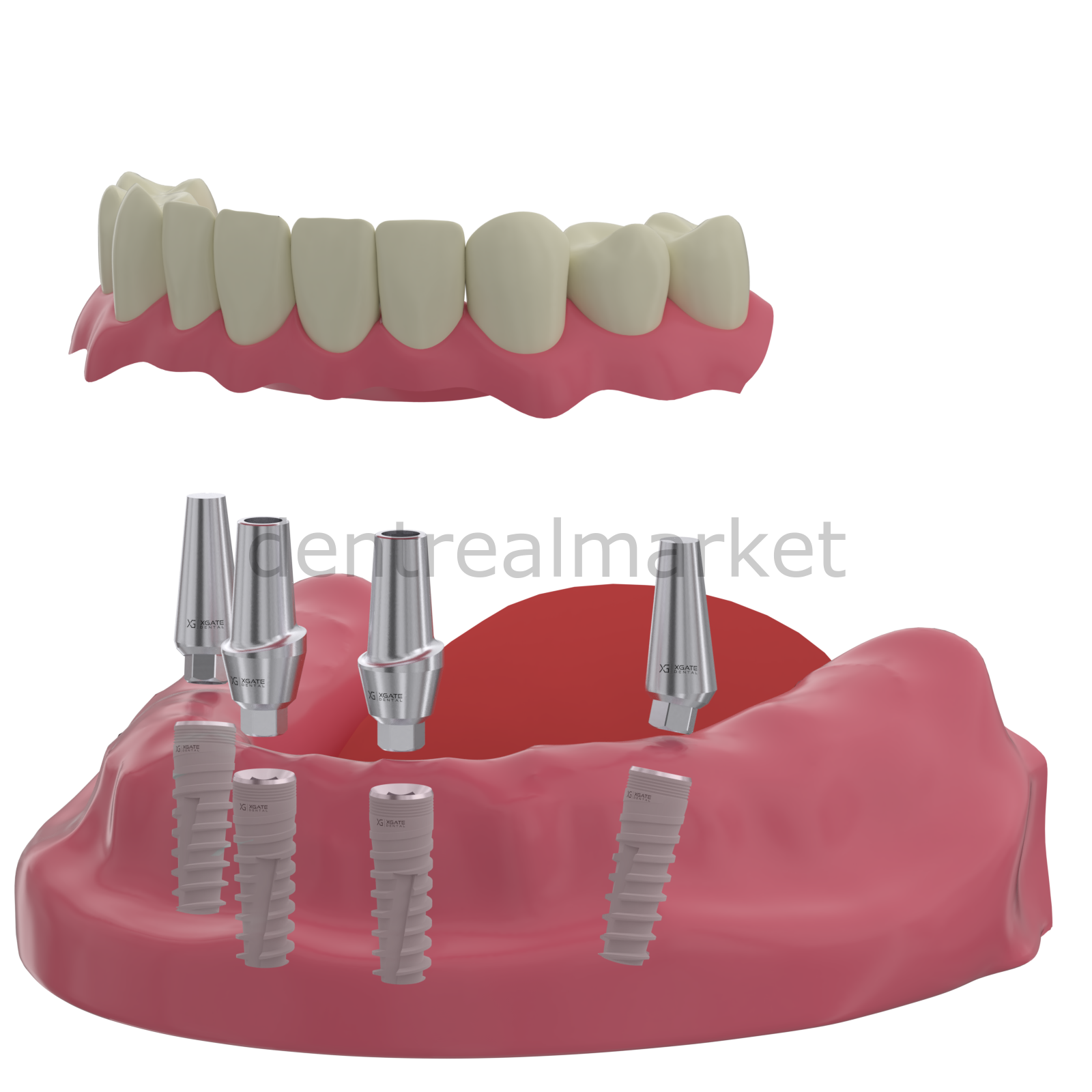 DentrealStore - X-Gate Dental X3 Internal Hex Implant Body - Diameter 3.3 mm - Single Platform Implant