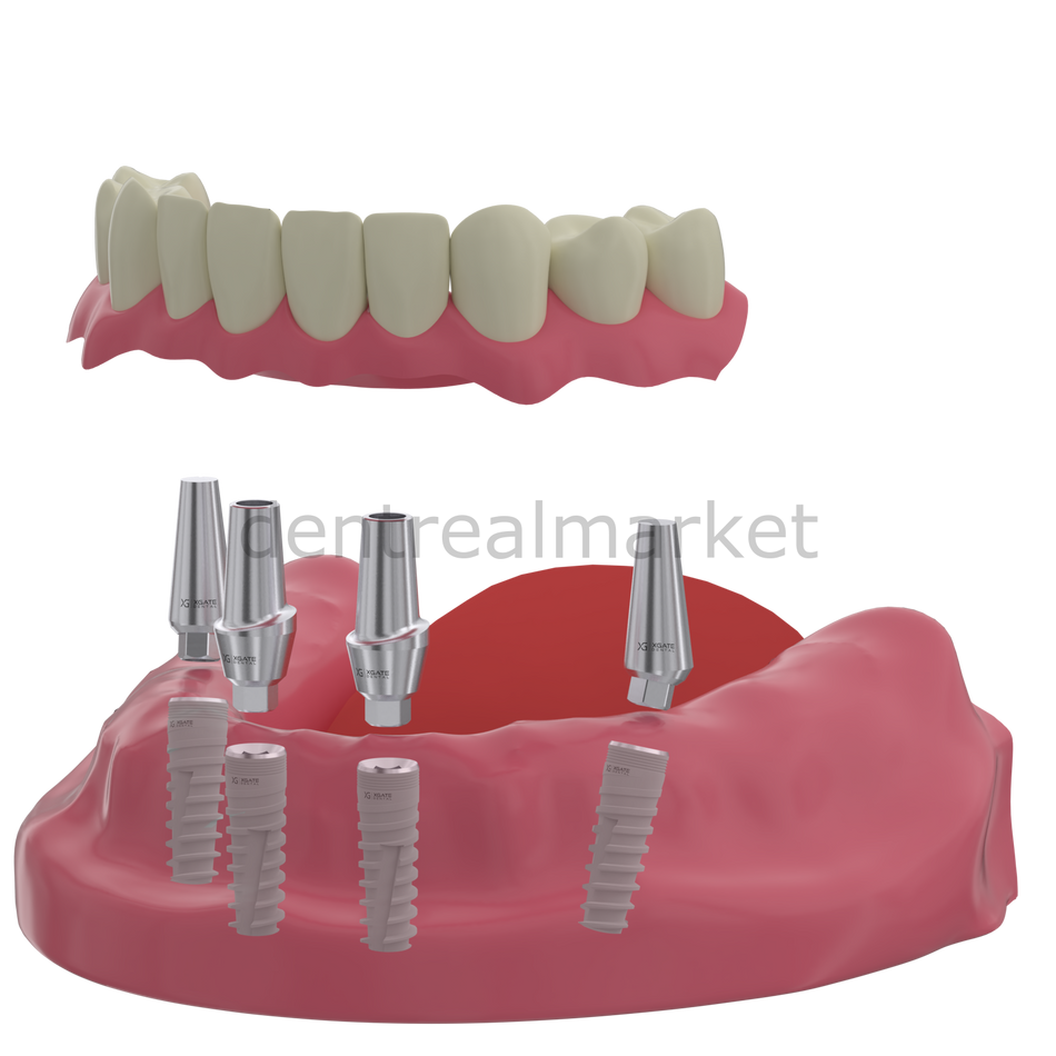 DentrealStore - X-Gate Dental X3 Internal Hex Implant Body - Diameter 5.0 mm - Single Platform Implant