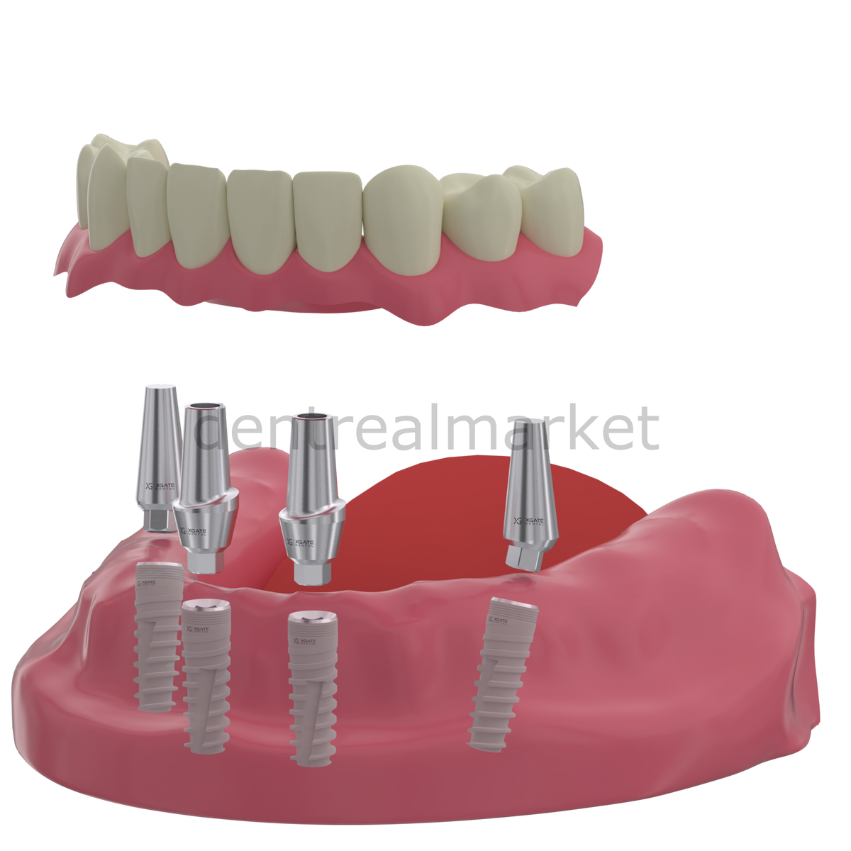 DentrealStore - X-Gate Dental X3 Internal Hex Implant Body - Diameter 3.75 mm - Single Platform Implant