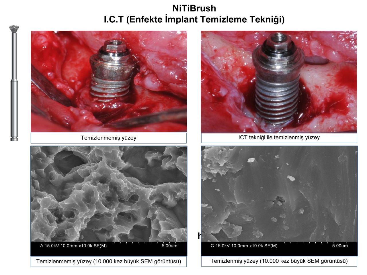 Dentkonsept - Nitibrush Peri - Implantitis Bur Nano