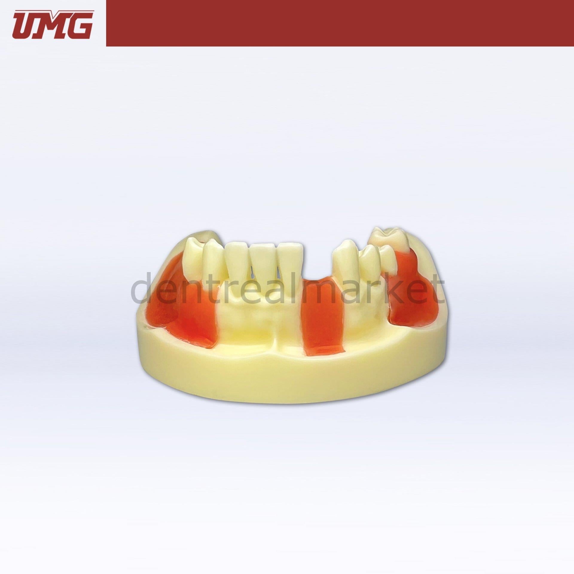 Umg Dental - Umg Model Implant Training Model With Gingiva