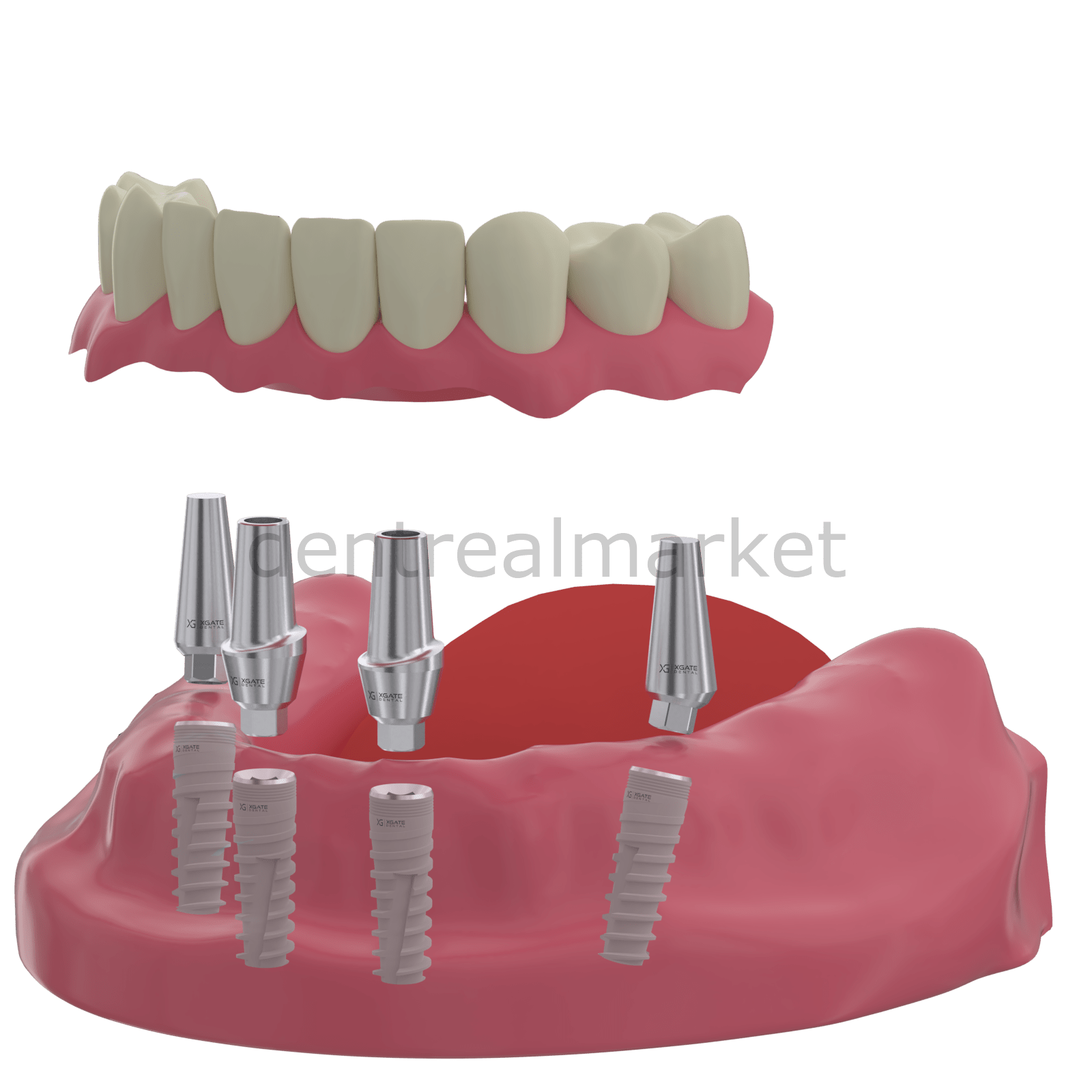 X - Gate Dental - X3 Internal Hex Implant Body - Diameter 3.3 mm - Single Platform Implant