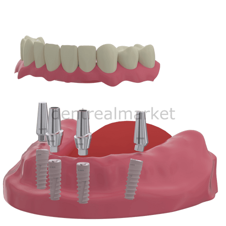 X - Gate Dental - X3 Internal Hex Implant Body - Diameter 4.2 mm - Single Platform Implant