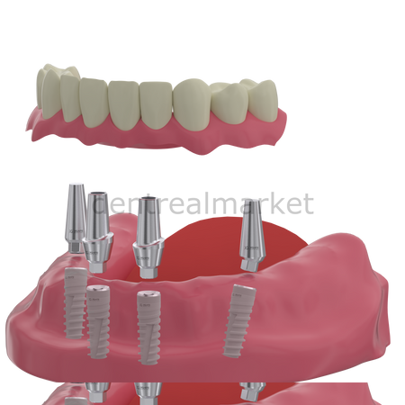 X - Gate Dental - X3 Internal Hex Implant Body - Diameter 4.2 mm - Single Platform Implant