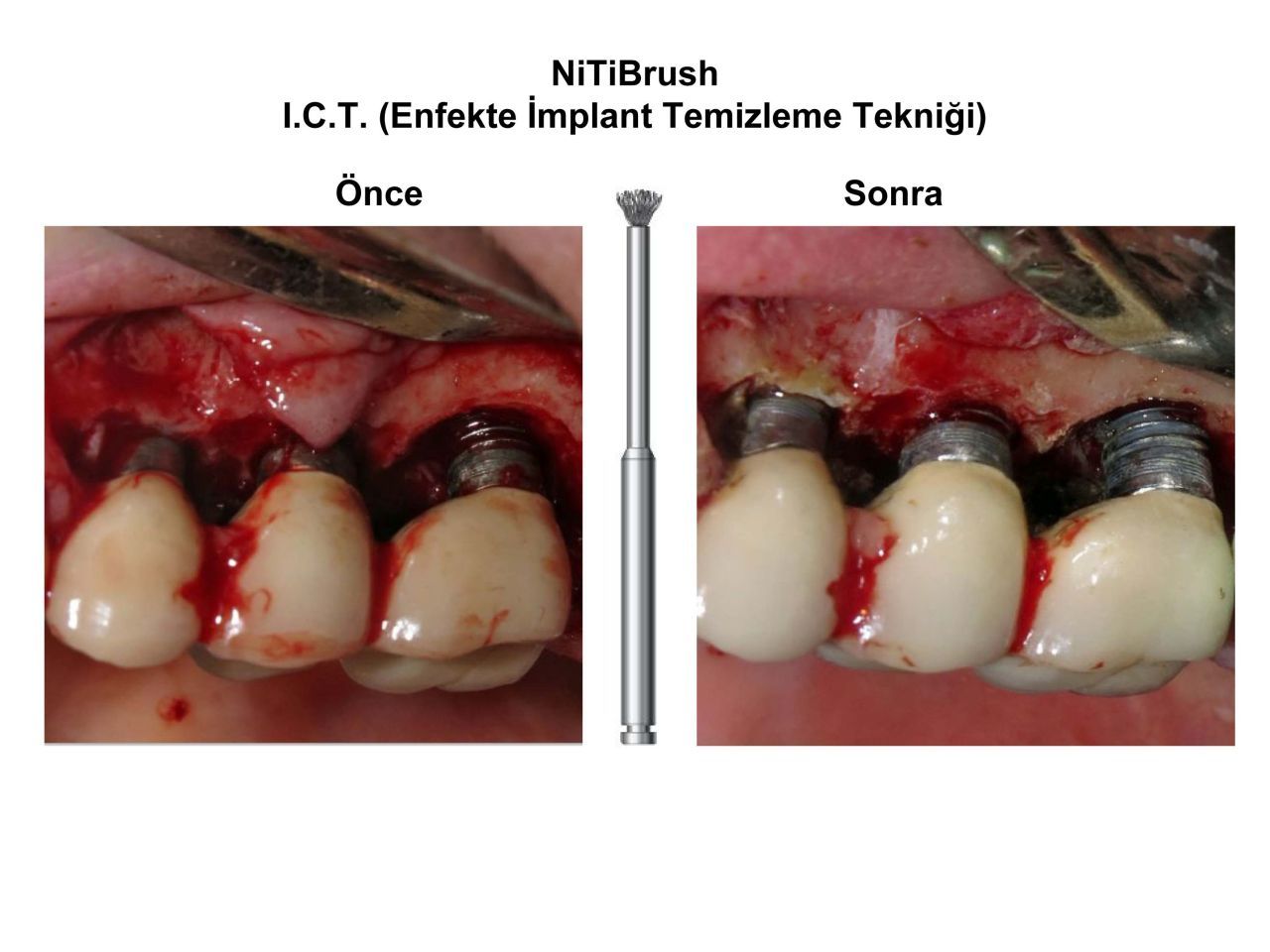 DentrealStore - Dentkonsept Niti Brush OMEGA Periimplantitis Bur