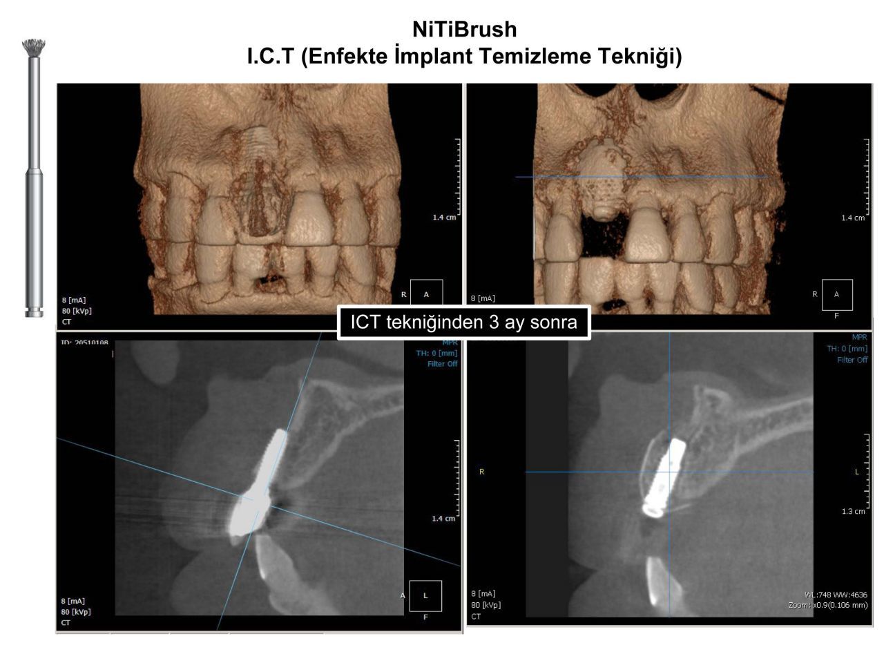 Nitibrush Peri-Implantitis Bur Set - 4 Pcs