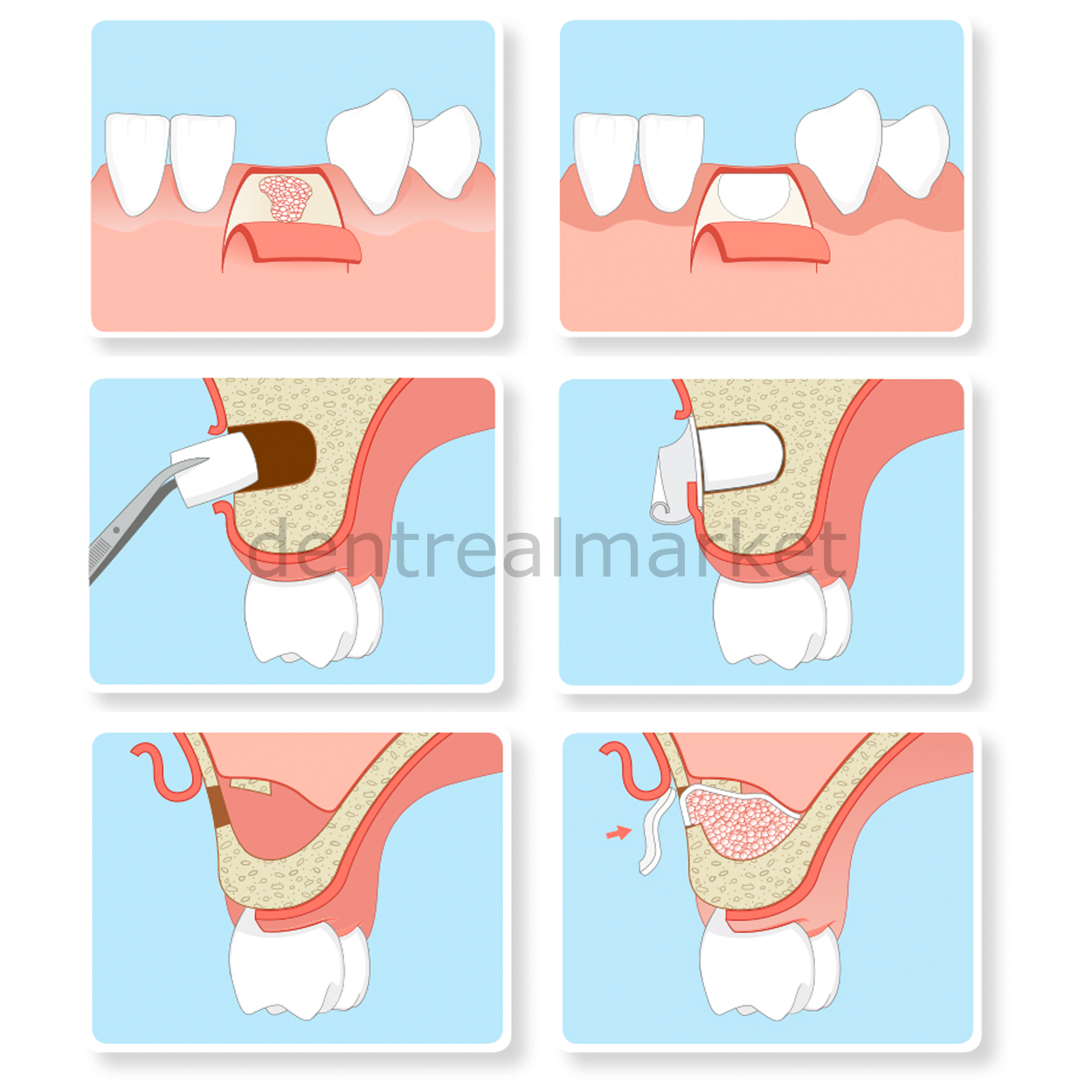 Parasorb Resodont Forte Dental Collagen Membrane - 32*25 mm
